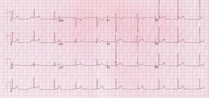 athlete-ecgs-how-to-interpret-and-know-when-and-how-to-investigate